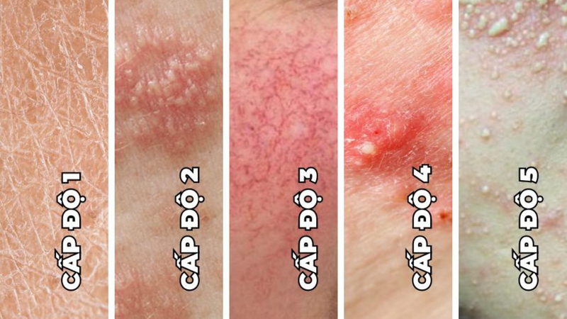 Da nhiễm corticoid có tiêm meso được không 1