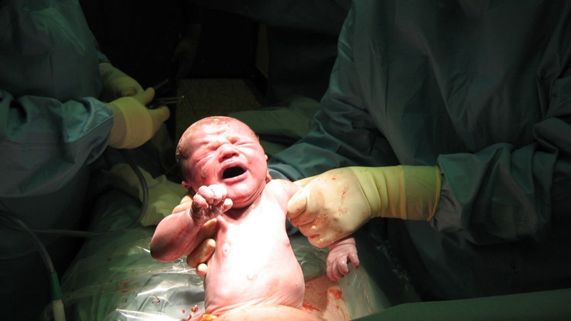 Đa ối có nên mổ sớm không? Trường hợp nào được chỉ định mổ sớm 1