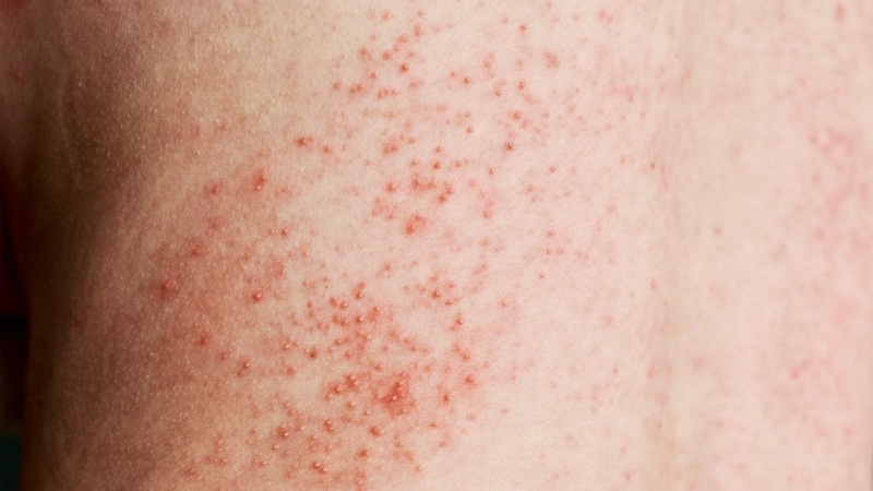 Da trẻ bị nổi sần như da gà: Nguyên nhân và phương pháp điều trị 2