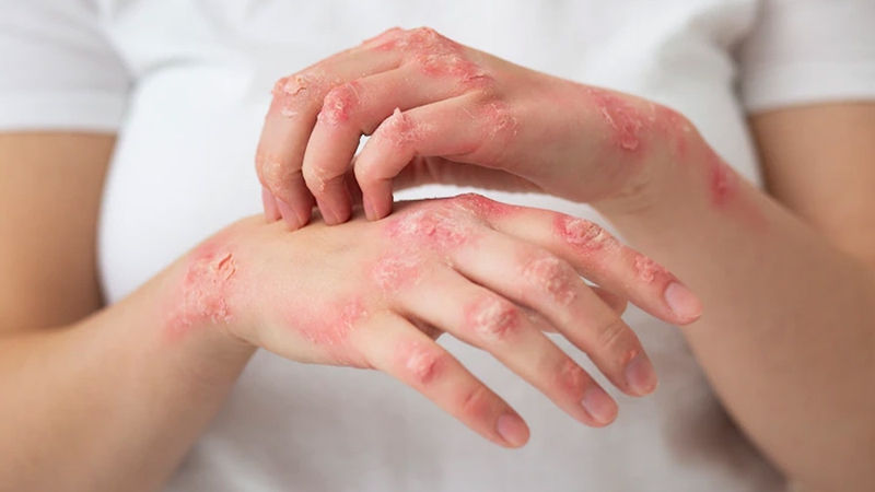 Dài hẹp bao quy đầu: Nguyên nhân và mức độ ảnh hưởng đến sức khỏe 3