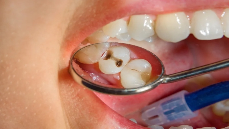 Đang niềng răng có tháo ra được không? 4