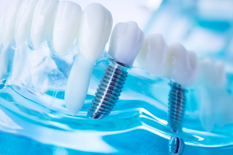 Đắp răng khểnh giữ được bao lâu? Ưu nhược điểm các phương pháp 2