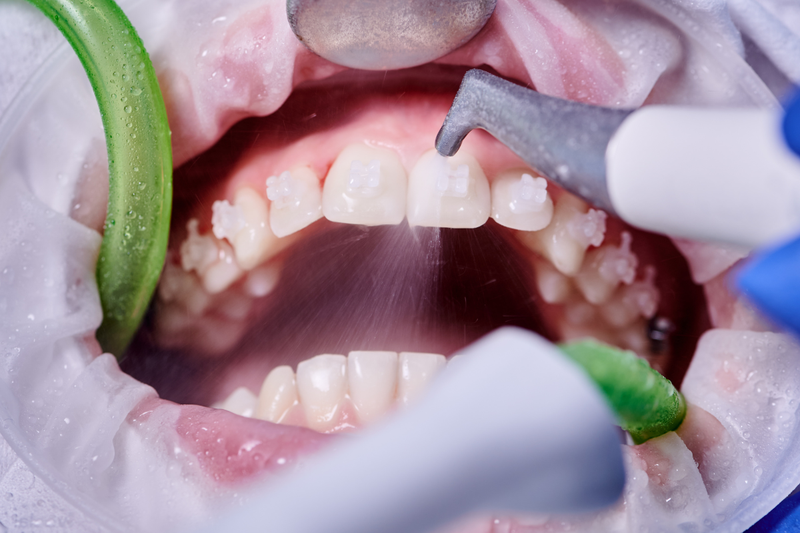 Đắp răng khểnh giữ được bao lâu? Ưu nhược điểm các phương pháp 3
