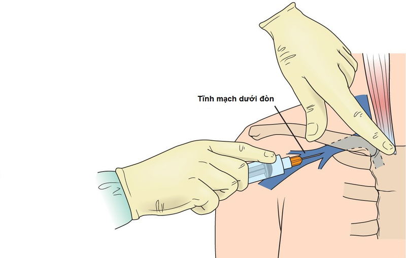 Tìm hiểu chi tiết về đặt catheter tĩnh mạch dưới đòn 1