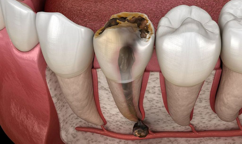 Đặt thuốc diệt tủy răng có đau không? 1