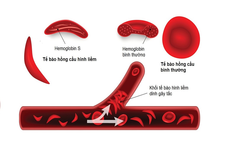 dau-bung-trai-duoi-xuong-suon-4.jpg