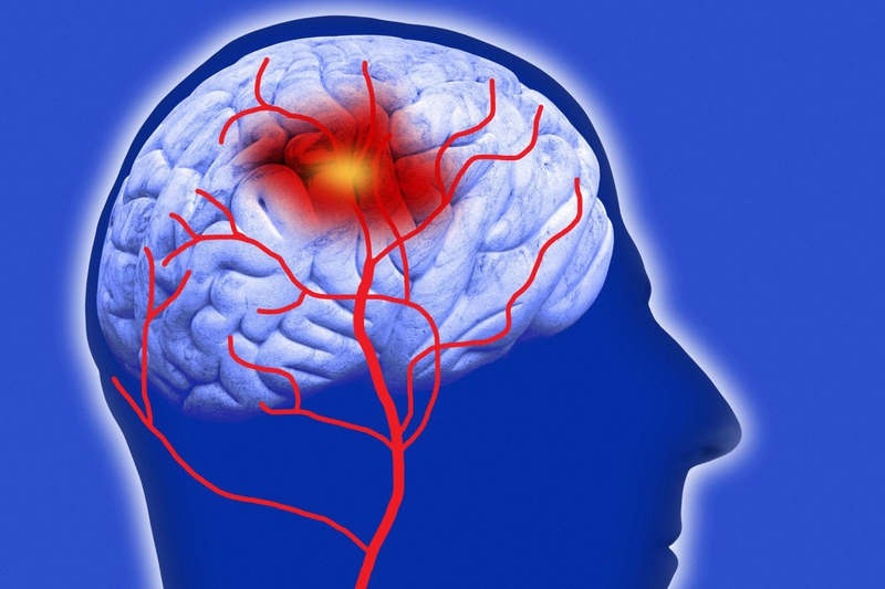 Dấu hiệu giúp bạn nhận biết đột quỵ xuất huyết não2