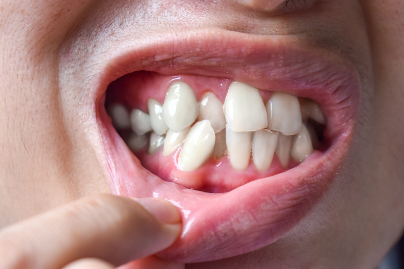 Dấu hiệu mọc răng khểnh đẹp là gì? Các kỹ thuật chỉnh nha cho răng khểnh 2