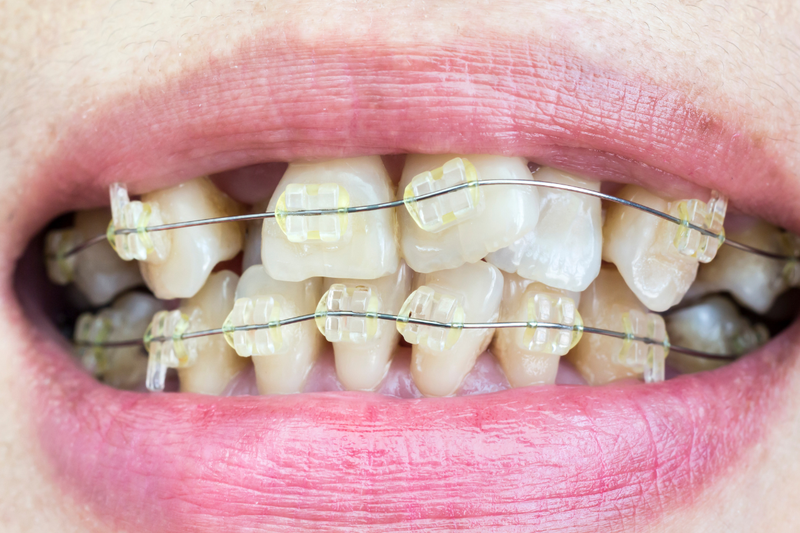 Dấu hiệu mọc răng khểnh đẹp là gì? Các kỹ thuật chỉnh nha cho răng khểnh 3