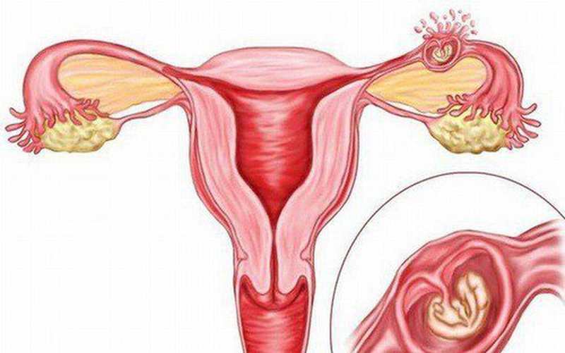 Dấu hiệu thai ngoài tử cung tự tiêu và những điều bạn cần biết 3