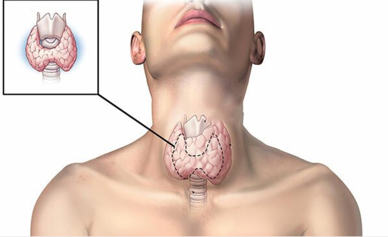 Những dấu hiệu viêm tuyến giáp có thể bạn chưa biết 2