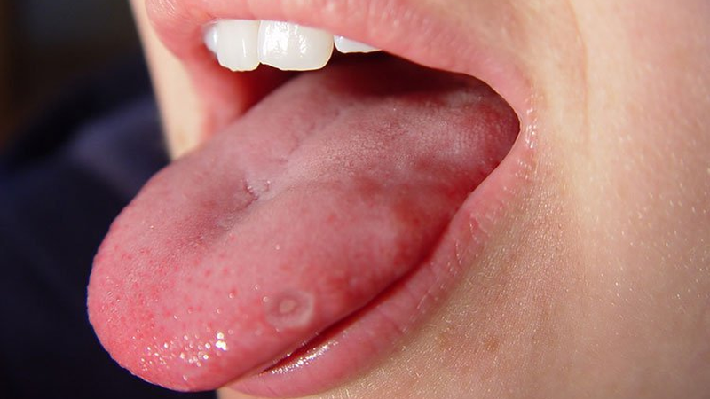 Đầu lưỡi nổi hột đỏ: Nguyên nhân và dấu hiệu nhận biết bệnh lý 1