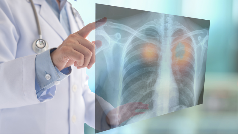 Đau ngực kiểu màng phổi là gì? Nguyên nhân và cách chẩn đoán 2
