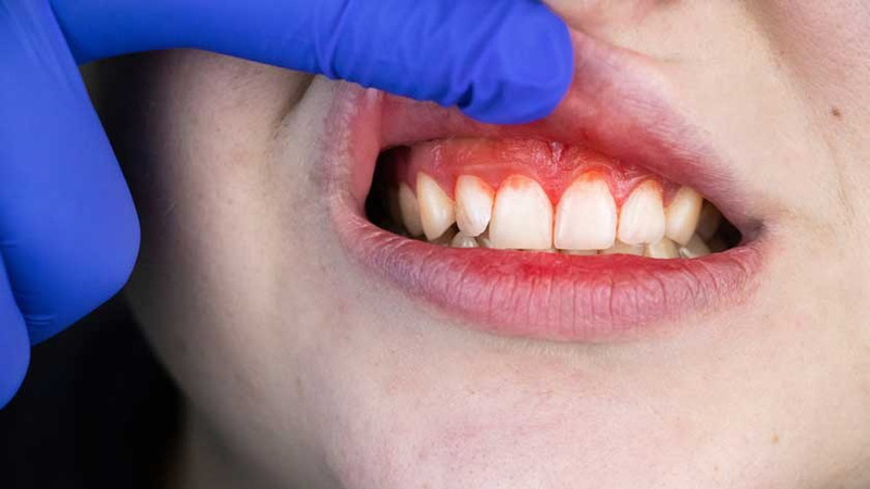 Nguyên nhân gây đau nhức răng cửa và cách khắc phục 1