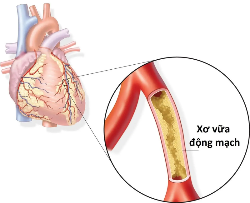 Đau thắt ngực là bệnh gì và cách phòng ngừa ra sao? 3