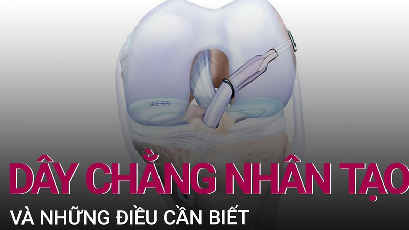 Dây chằng nhân tạo và những điều cần biết 1