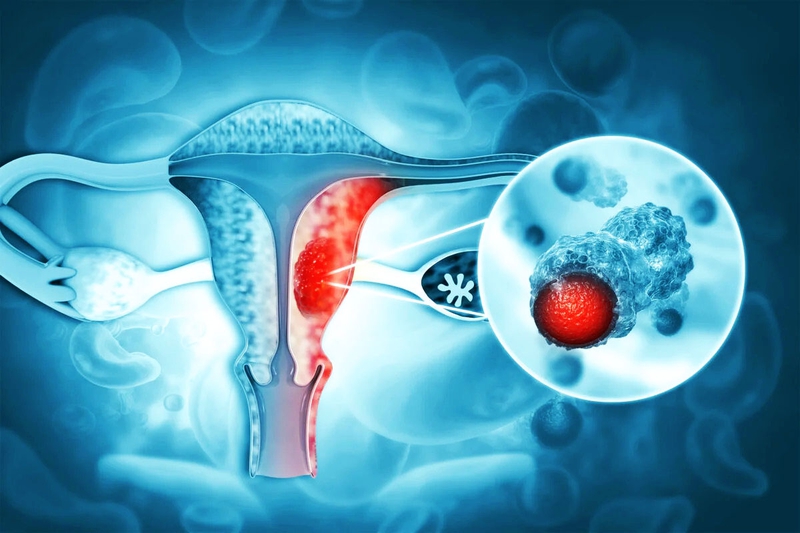 Dính buồng tử cung là gì? Nguyên nhân, triệu chứng và cách điều trị 7
