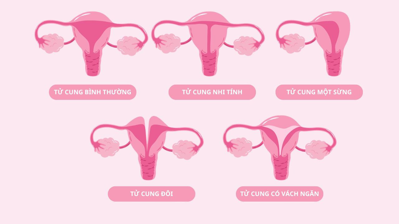 Dị dạng tử cung: Liệu có thể mang thai? 4