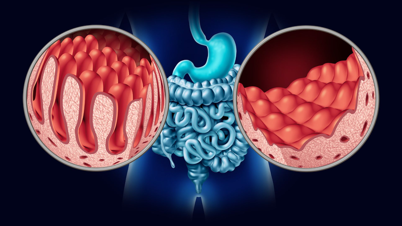 Đi ngoài phân sống sút cân là dấu hiệu của bệnh celiac