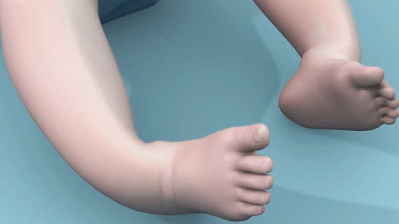 Các dạng dị tật bàn chân thường gặp 2