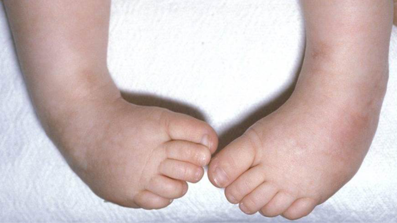Dị tật bàn chân thường gặp theo nhóm tuổi 2