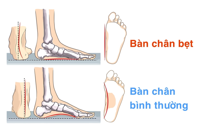 Dị tật bàn chân thường gặp theo nhóm tuổi 3