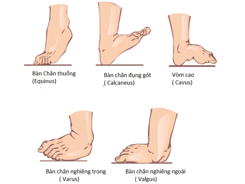 Bàn chân nghiêng vào trong là một trong những dấu hiệu của dị tật bàn chân vẹo