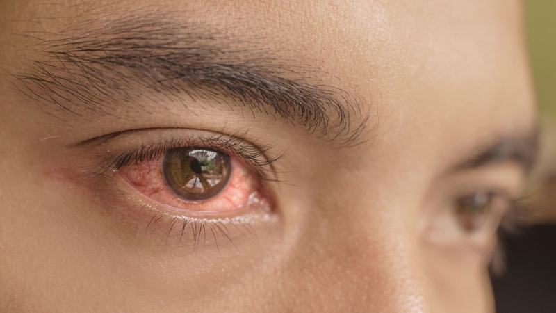 Dị ứng mắt: Nguyên nhân, triệu chứng, phương pháp điều trị 4
