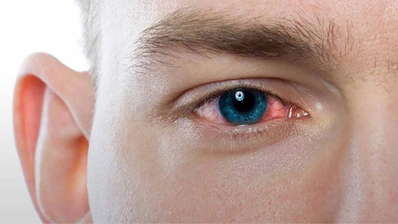 Dị vật trong mắt là gì? Nguyên nhân, dấu hiệu và các biến chứng nguy hiểm 3