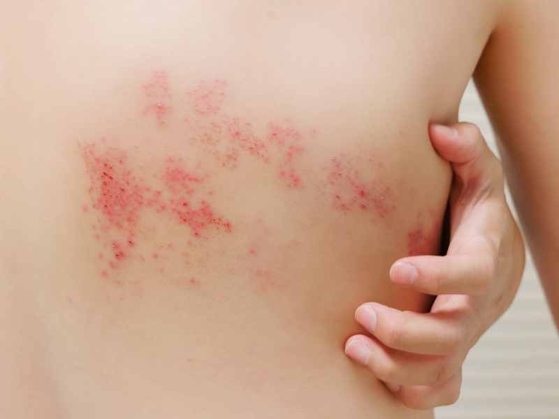 Địa chỉ nào tiêm ngừa zona ở Long An uy tín và an toàn? Lợi ích của việc tiêm ngừa zona 1