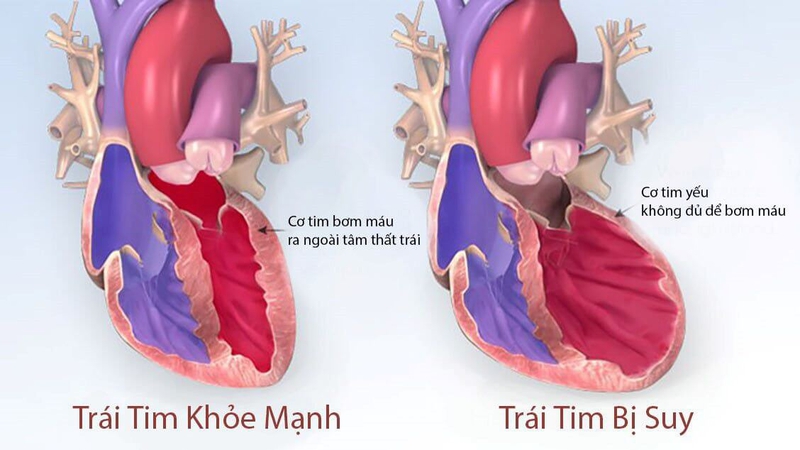 Điểm danh các bệnh lý gây suy tim thường gặp 1