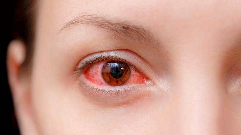 Điểm mặt 4 bệnh về mắt thường gặp mùa hè và cách phòng tránh 2