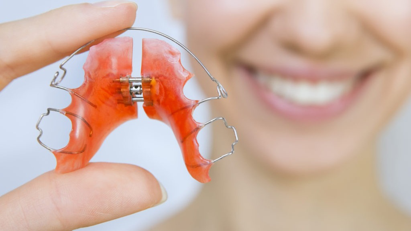 Điều gì xảy ra nếu niềng răng xong không đeo hàm duy trì 1
