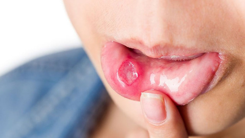 Điều trị nhiệt miệng tái phát thường xuyên như thế nào?