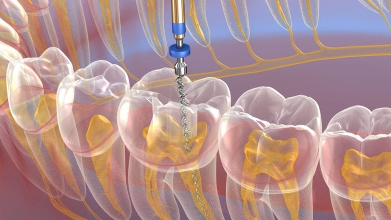 Điều trị nội nha là gì? Tại sao cần phải điều trị nội nha? 4