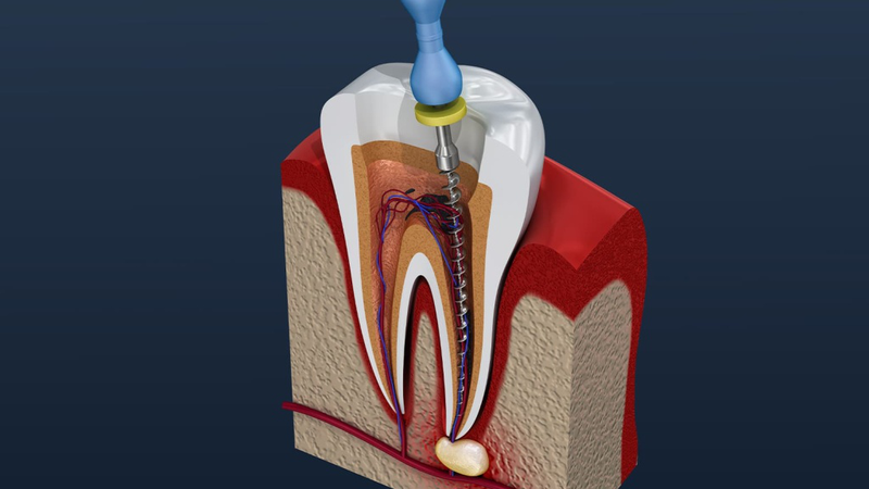 Điều trị nội nha là gì? Tại sao cần phải điều trị nội nha? 2