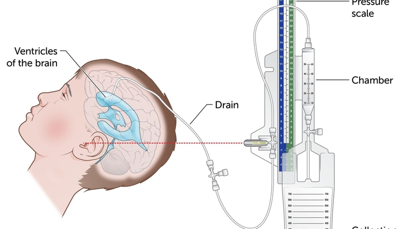 Điều trị tăng áp lực nội sọ và quản lý sau điều trị 4