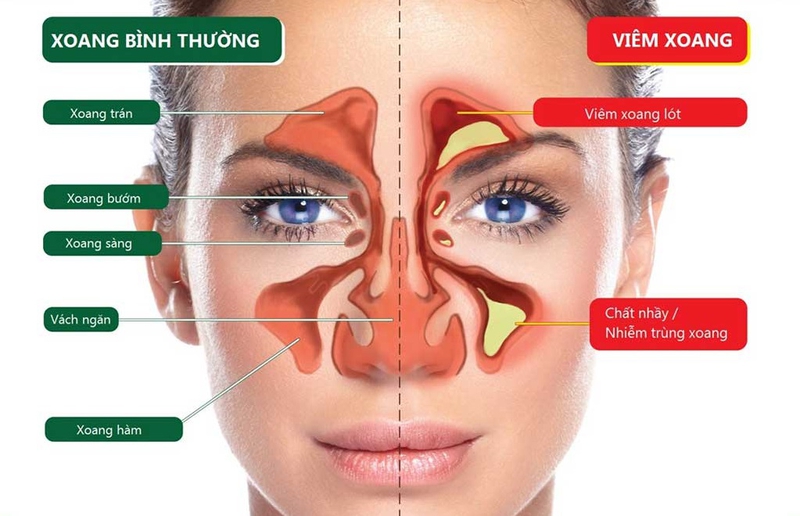 Thực Phẩm Hỗ Trợ Điều Trị Đau Xoang Trán