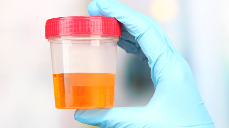 Định lượng protein niệu là quá trình đo lường lượng protein có trong nước tiểu