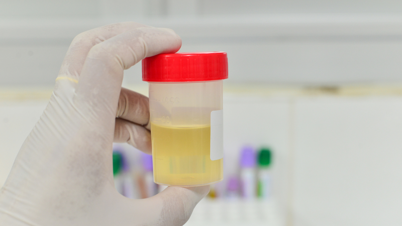 Kết quả âm tính cho thấy không có sự hiện diện bất thường của protein trong nước tiểu hoặc lượng protein rất thấp