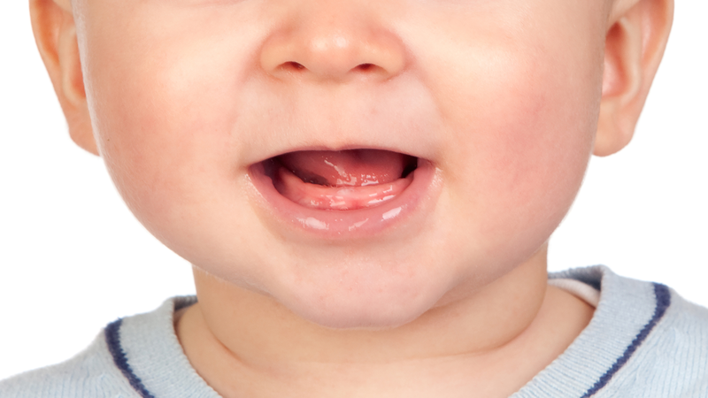Dính thắng môi trên ở trẻ: Dấu hiệu nhận biết và cách điều trị hiệu quả 1