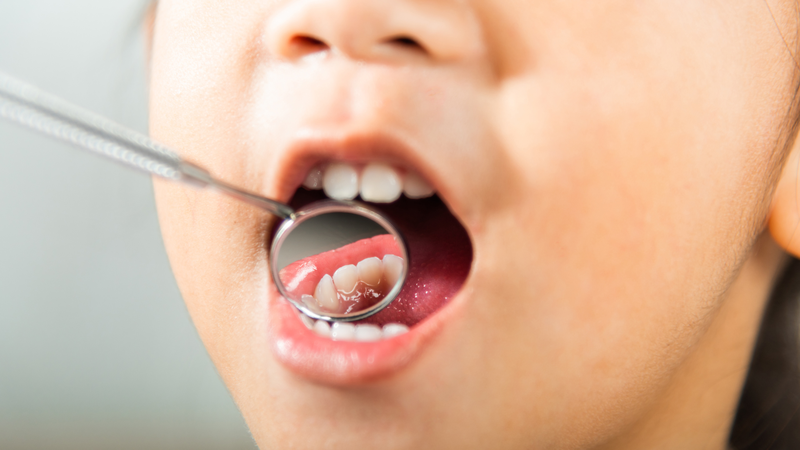 Dính thắng môi trên ở trẻ: Dấu hiệu nhận biết và cách điều trị hiệu quả 5