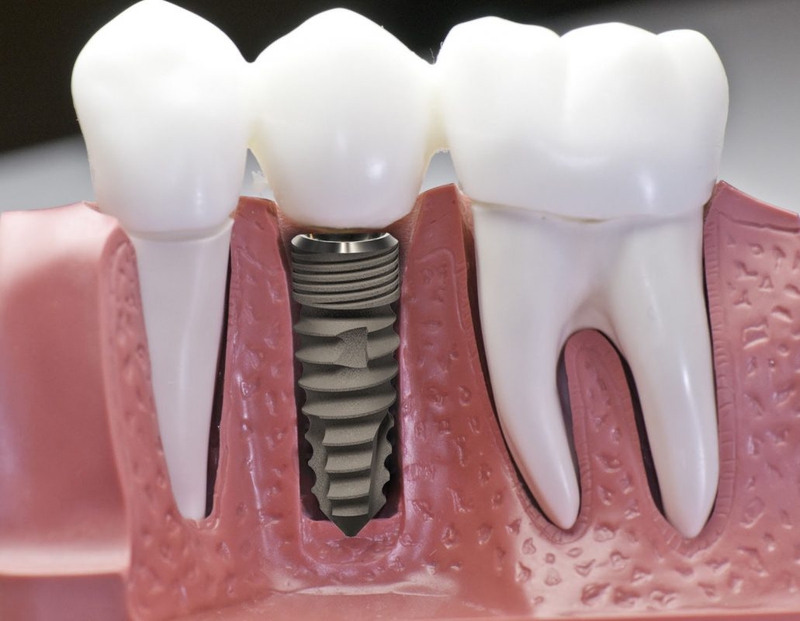 Trụ DIO Implant có tốt hay không? 1