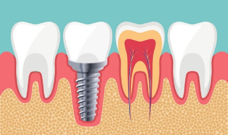 Trụ DIO Implant có tốt hay không? 2