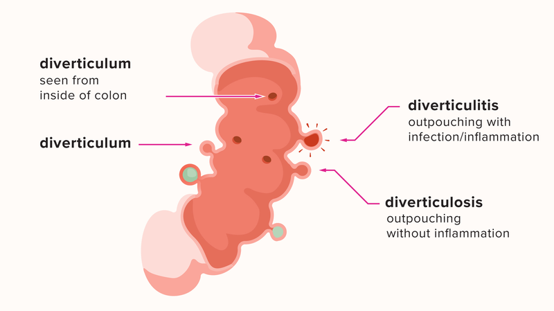 Diverticulitis là gì? Có nguy hiểm hay không? 1