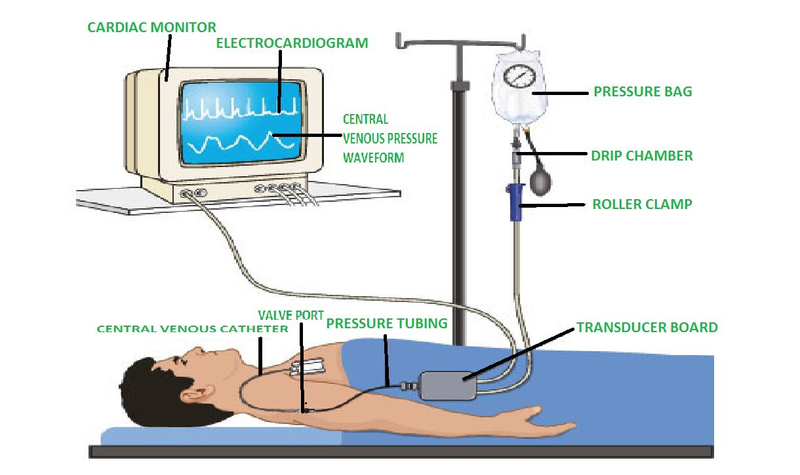 Đo CVP là gì? Quy trình thực hiện đo CVP không phải ai cũng biết 3