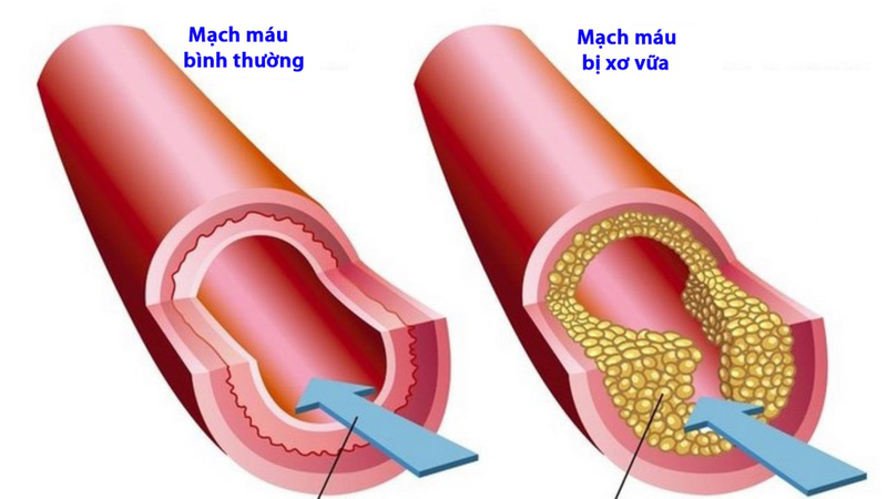 Động mạch chậu: Cấu trúc, chức năng và các bệnh lý thường gặp 3