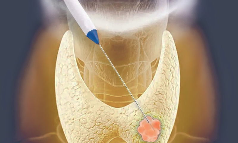 Đốt sóng cao tần: Phương pháp điều trị được ứng dụng hiệu quả 2