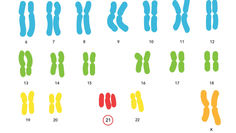 Bộ nhiễm sắc thể của người mắc hội chứng Down