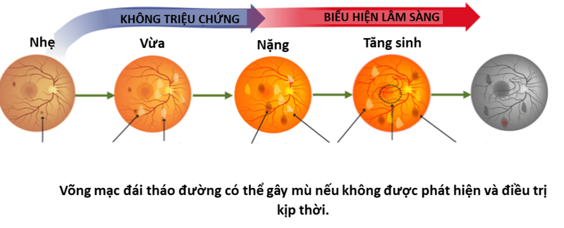 Bệnh võng mạc đái tháo đường: Một căn bệnh thường gặp và âm thầm4